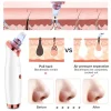 blackhead remover 2